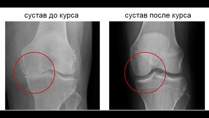 Рентген до и после